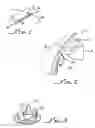 Fig. 02 - Implant device with a retinoid for improved biocompatibility