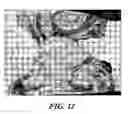 Fig. 09 - Composite medical device having a titanium or titanium based alloy section and a ferrous metal section