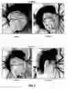 Fig. 04 - Method of inhibiting angiogenesis