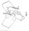 Fig. 06 - Transobturator surgical articles and methods