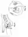 Fig. 10 - Transobturator surgical articles and methods