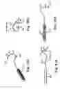 Fig. 15 - Transobturator surgical articles and methods