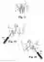Fig. 22 - Transobturator surgical articles and methods