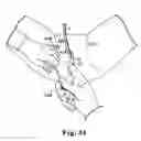 Fig. 23 - Transobturator surgical articles and methods