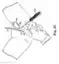 Fig. 24 - Transobturator surgical articles and methods