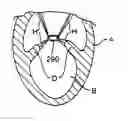 Fig. 01 - Chordae capturing methods for stress reduction