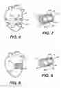 Fig. 05 - Chordae capturing methods for stress reduction