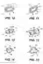 Fig. 06 - Chordae capturing methods for stress reduction