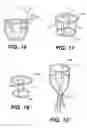 Fig. 07 - Chordae capturing methods for stress reduction