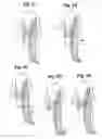 Fig. 06 - Lymphedema treatment system