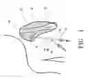 Fig. 02 - Blood treatment catheter and method