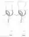 Fig. 04 - Cystotomy catheter capture device and methods of using same