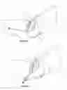 Fig. 12 - Cystotomy catheter capture device and methods of using same
