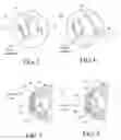 Fig. 03 - Method of treatment of refractive errors using subepithelial or intrastromal corneal inlay with bonding coating