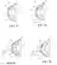 Fig. 05 - Method of treatment of refractive errors using subepithelial or intrastromal corneal inlay with bonding coating