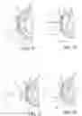 Fig. 07 - Method of treatment of refractive errors using subepithelial or intrastromal corneal inlay with bonding coating