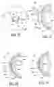 Fig. 09 - Method of treatment of refractive errors using subepithelial or intrastromal corneal inlay with bonding coating