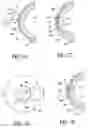 Fig. 10 - Method of treatment of refractive errors using subepithelial or intrastromal corneal inlay with bonding coating