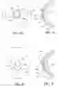 Fig. 12 - Method of treatment of refractive errors using subepithelial or intrastromal corneal inlay with bonding coating