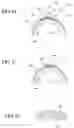 Fig. 22 - Method of treatment of refractive errors using subepithelial or intrastromal corneal inlay with bonding coating