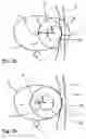 Fig. 03 - Method for delimiting cryoablation by controlled cooling