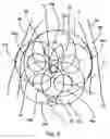 Fig. 06 - Method for delimiting cryoablation by controlled cooling