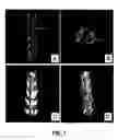 Fig. 08 - Bone treatment instrument and method