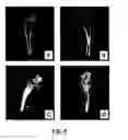 Fig. 09 - Bone treatment instrument and method