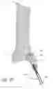 Fig. 20 - Bone fixation system with radially extendable anchor