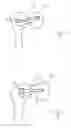 Fig. 04 - Double compression unloadable screw system