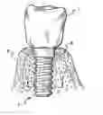 Fig. 01 - Osteointegrative interface for implantable prostheses and a method for the treatment of the osteointegrative interface