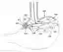 Fig. 01 - Endoscopic gastric constriction device