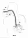 Fig. 04 - Endoscopic gastric constriction device