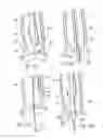 Fig. 27 - Distal wire stop