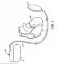 Fig. 02 - Apparatus for detecting and treating ventricular arrhythmia