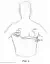 Fig. 10 - Apparatus for detecting and treating ventricular arrhythmia