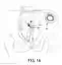 Fig. 14 - Method and system for providing pulsed electrical stimulation to sacral plexus of a patient to provide therapy for urinary incontinence and urological disorders
