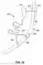 Fig. 22 - Gastrointestinal anchor with optimal surface area