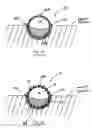 Fig. 33 - Systems and methods for overcoming or preventing vascular flow restrictions