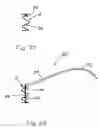 Fig. 48 - Systems and methods for overcoming or preventing vascular flow restrictions