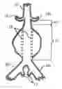 Fig. 01 - Method and system for fixation of endoluminal devices