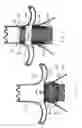 Fig. 04 - Method and system for fixation of endoluminal devices