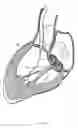 Fig. 06 - Methods and apparatus for endovascularly replacing a heart valve
