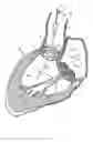 Fig. 10 - Methods and apparatus for endovascularly replacing a heart valve