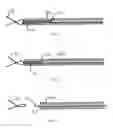 Fig. 13 - Methods and apparatus for endovascularly replacing a heart valve