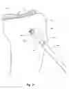 Fig. 22 - Tibial condylar hemiplasty implants, anchor assemblies, and related methods