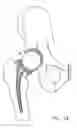 Fig. 08 - One piece snap fit acetabular cup