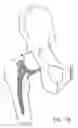 Fig. 09 - One piece snap fit acetabular cup