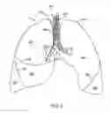 Fig. 03 - Bronchial flow control devices and methods of use