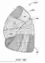 Fig. 05 - Bronchial flow control devices and methods of use
